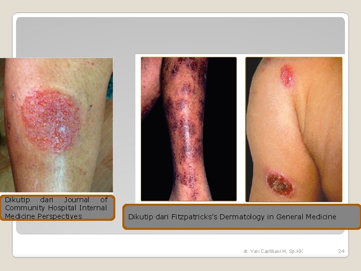 Dikutip dari Journal of Community Hospital Internal Medicine Perspectives Dikutip dari Fitzpatricks’s Dermatology in Dikutip dari Journal of Community Hospital Internal Medicine Perspectives Dikutip dari Fitzpatricks’s Dermatology in