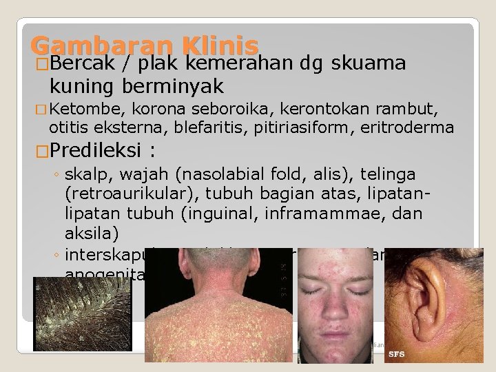 Gambaran Klinis �Bercak / plak kemerahan dg skuama kuning berminyak � Ketombe, korona seboroika, Gambaran Klinis �Bercak / plak kemerahan dg skuama kuning berminyak � Ketombe, korona seboroika,