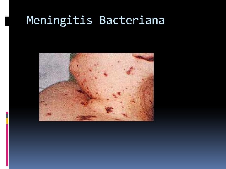 Meningitis Bacteriana 