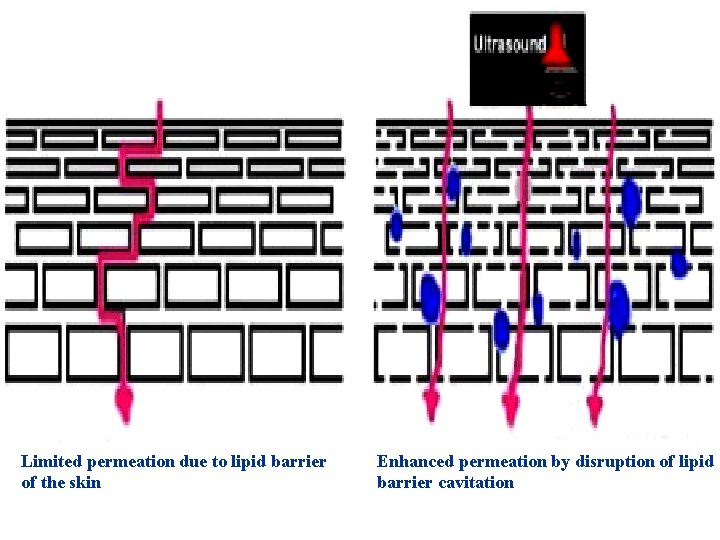 Limited permeation due to lipid barrier of the skin Enhanced permeation by disruption of