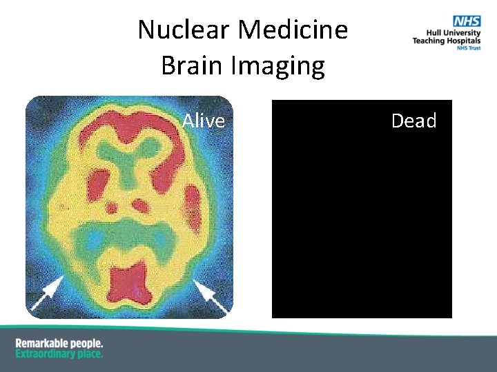 Nuclear Medicine Brain Imaging Alive Dead Nuclear Medicine Brain Imaging Alive Dead