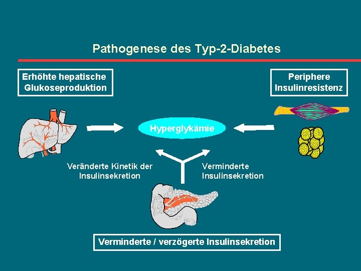 Pathogenese des Typ-2 -Diabetes Erhöhte hepatische Glukoseproduktion Periphere Insulinresistenz Hyperglykämie Veränderte Kinetik der Insulinsekretion