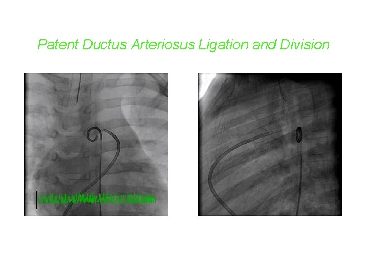 Patent Ductus Arteriosus Ligation and Division 