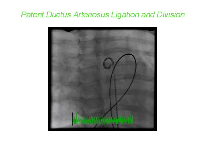 Patent Ductus Arteriosus Ligation and Division 