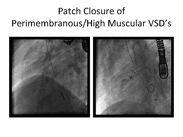 Patch Closure of Perimembranous/High Muscular VSD’s 