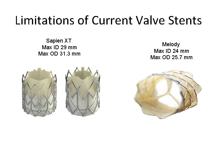 Limitations of Current Valve Stents Sapien XT Max ID 29 mm Max OD 31.