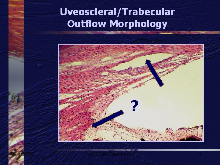 Uveoscleral/Trabecular Outflow Morphology ? 1/2/2022 ASCRS 2006 San. Francisco 4 
