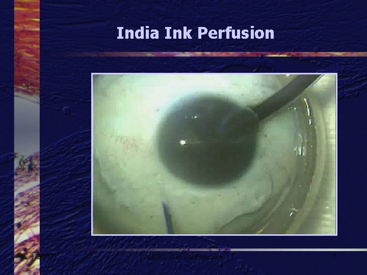 India Ink Perfusion 1/2/2022 ASCRS 2006 San. Francisco 7 