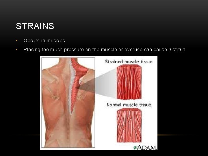STRAINS • Occurs in muscles • Placing too much pressure on the muscle or