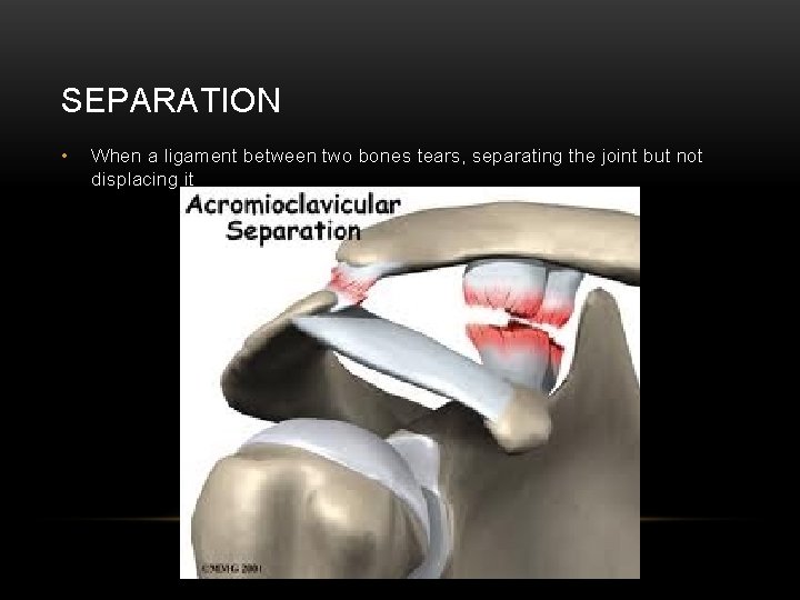 SEPARATION • When a ligament between two bones tears, separating the joint but not