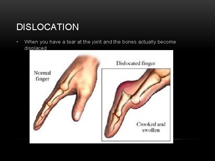 DISLOCATION • When you have a tear at the joint and the bones actually