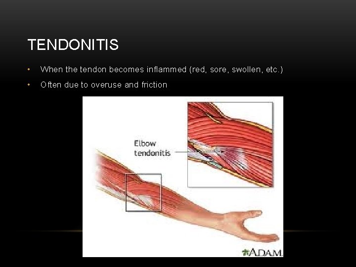 TENDONITIS • When the tendon becomes inflammed (red, sore, swollen, etc. ) • Often