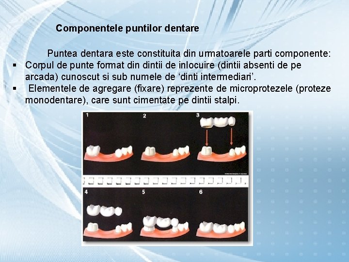 Componentele puntilor dentare Puntea dentara este constituita din urmatoarele parti componente: § Corpul de