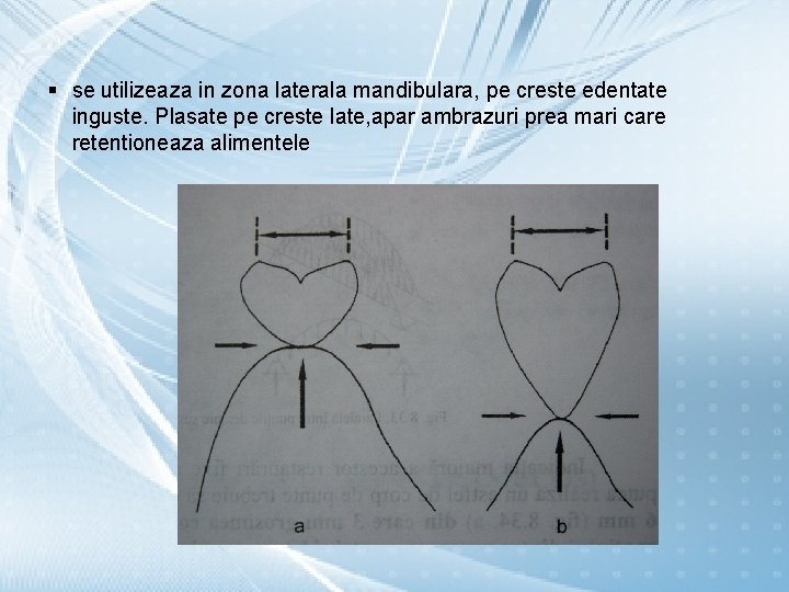 § se utilizeaza in zona laterala mandibulara, pe creste edentate inguste. Plasate pe creste