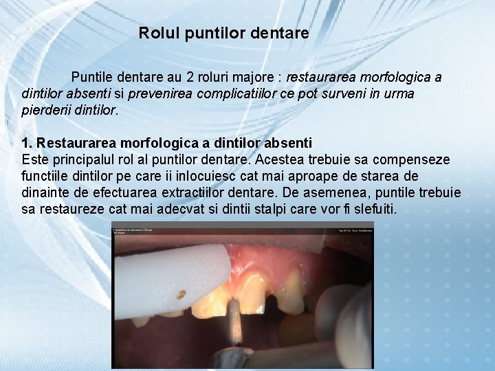 Rolul puntilor dentare Puntile dentare au 2 roluri majore : restaurarea morfologica a dintilor