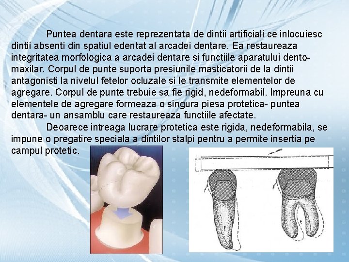 Puntea dentara este reprezentata de dintii artificiali ce inlocuiesc dintii absenti din spatiul edentat