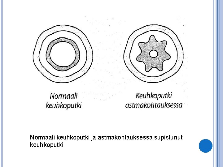 Normaali keuhkoputki ja astmakohtauksessa supistunut keuhkoputki 