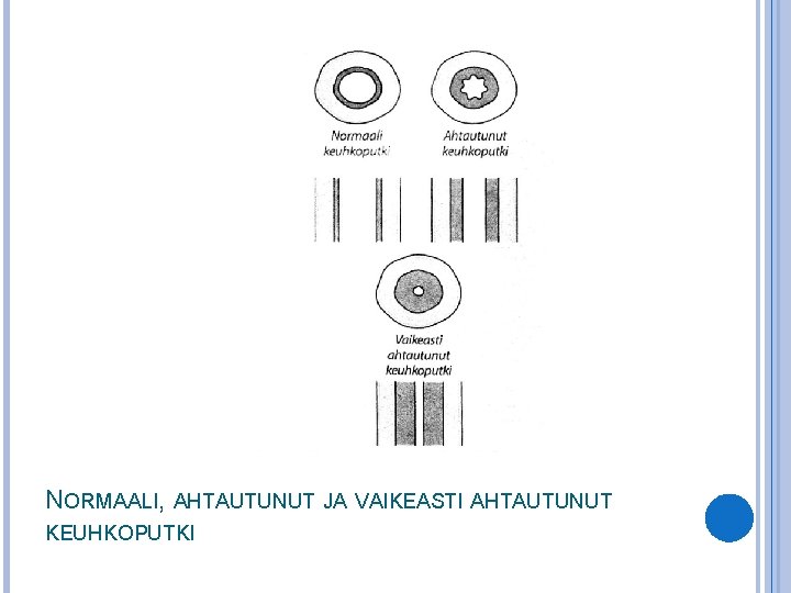 NORMAALI, AHTAUTUNUT JA VAIKEASTI AHTAUTUNUT KEUHKOPUTKI 