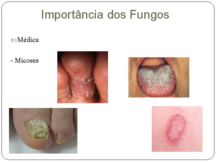 Importância dos Fungos Médica - Micoses 