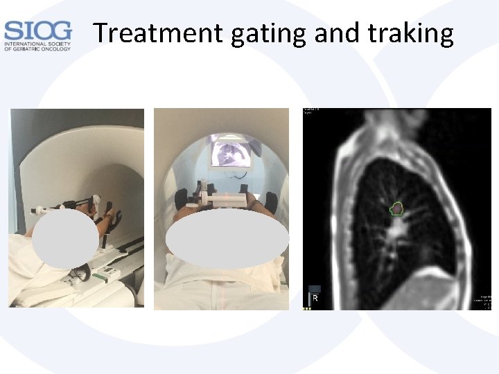 Treatment gating and traking 