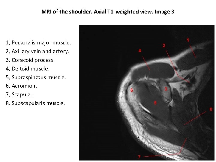 MRI of the shoulder. Axial T 1 -weighted view. Image 3 1, Pectoralis major