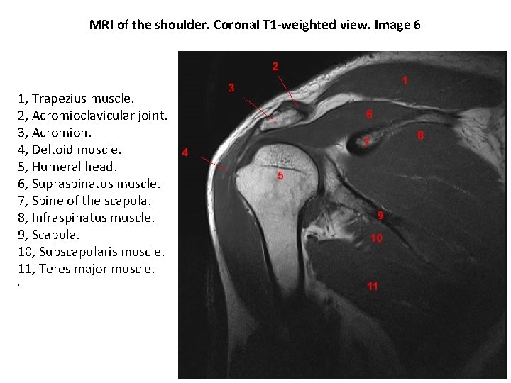 MRI of the shoulder. Coronal T 1 -weighted view. Image 6 1, Trapezius muscle.