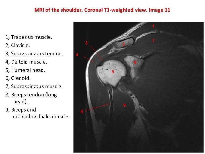 MRI of the shoulder. Coronal T 1 -weighted view. Image 11 1, Trapezius muscle.