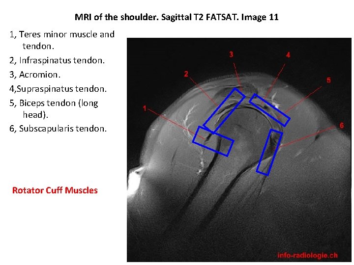 MRI of the shoulder. Sagittal T 2 FATSAT. Image 11 1, Teres minor muscle