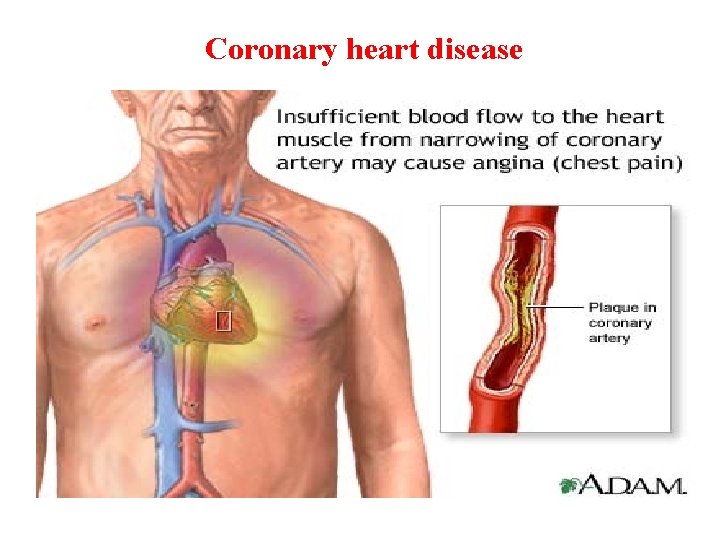 Coronary heart disease 