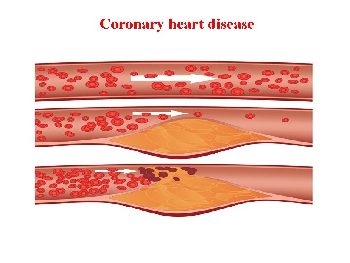 Coronary heart disease 