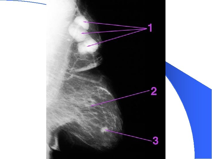 Mammogram 