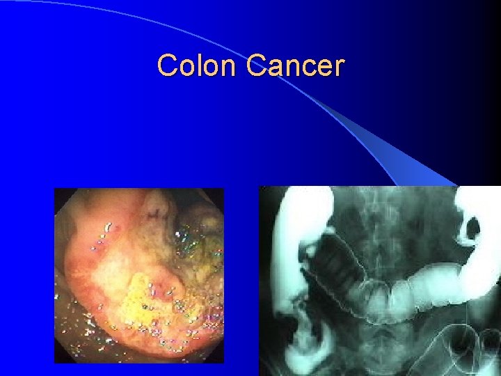 Colon Cancer 