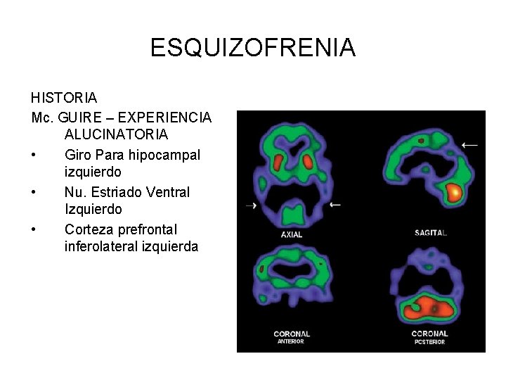 ESQUIZOFRENIA HISTORIA Mc. GUIRE – EXPERIENCIA ALUCINATORIA • Giro Para hipocampal izquierdo • Nu.