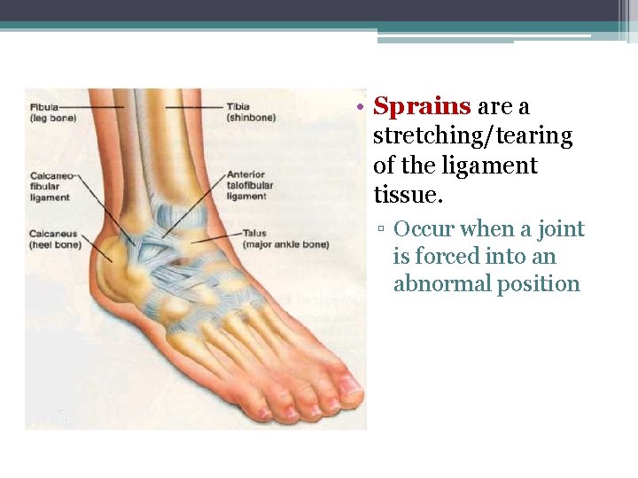  • Sprains are a stretching/tearing of the ligament tissue. ▫ Occur when a