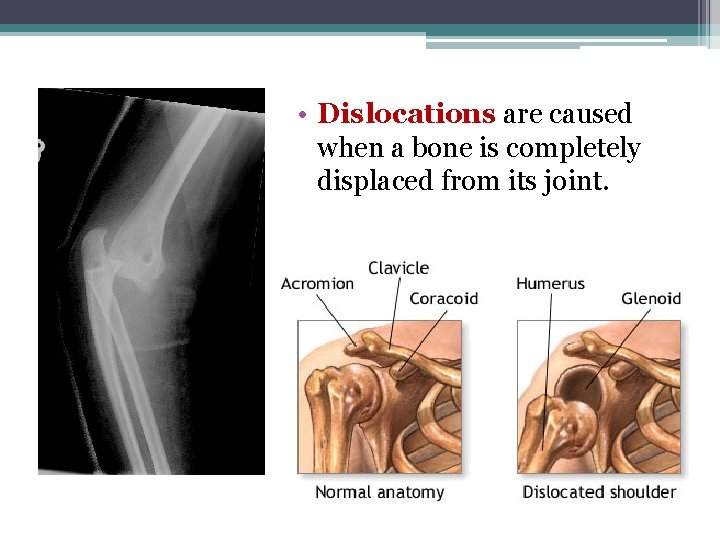  • Dislocations are caused when a bone is completely displaced from its joint.