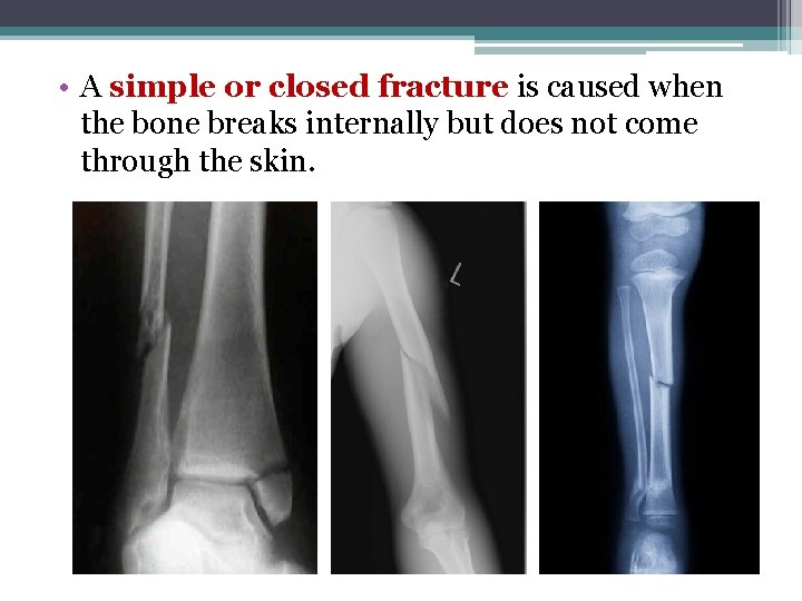  • A simple or closed fracture is caused when the bone breaks internally