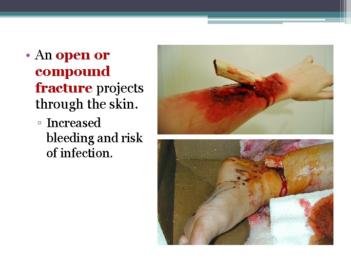  • An open or compound fracture projects through the skin. ▫ Increased bleeding