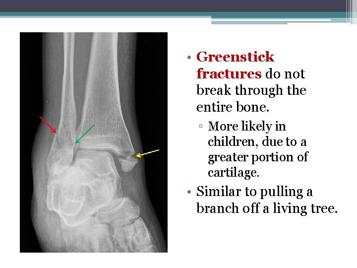  • Greenstick fractures do not break through the entire bone. ▫ More likely