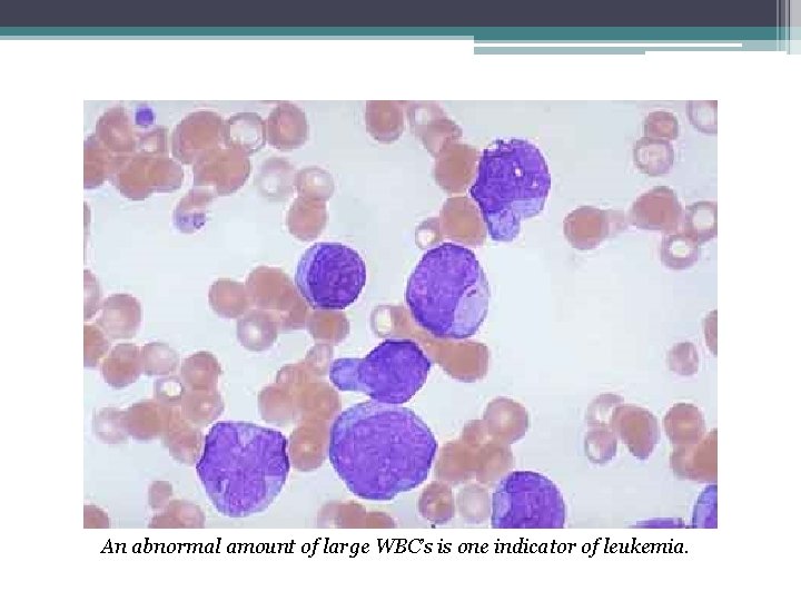 An abnormal amount of large WBC’s is one indicator of leukemia. 
