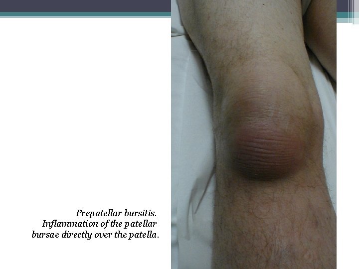 Prepatellar bursitis. Inflammation of the patellar bursae directly over the patella. 