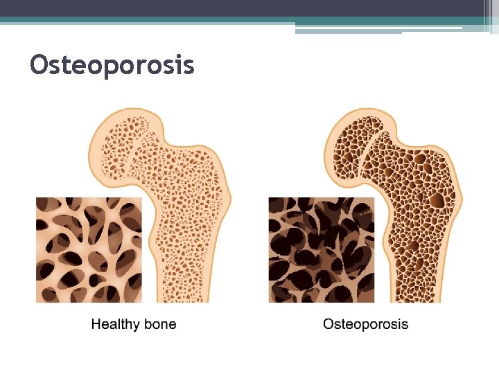 Osteoporosis 