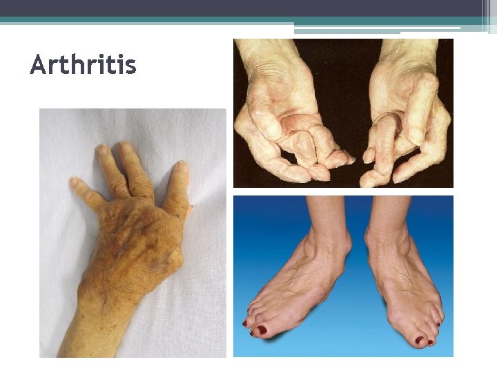 Arthritis 