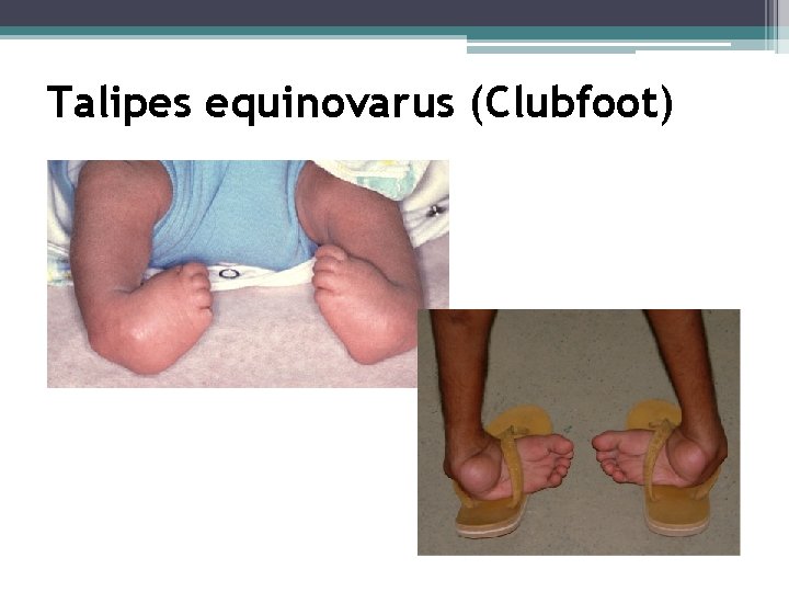 Talipes equinovarus (Clubfoot) 