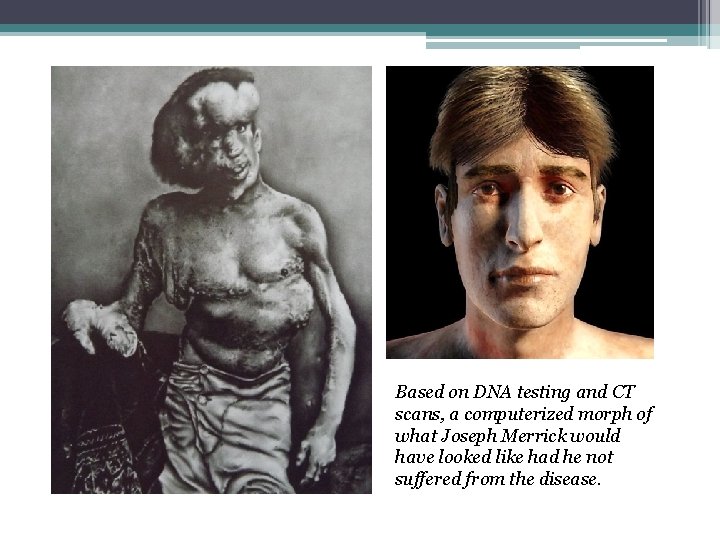 Based on DNA testing and CT scans, a computerized morph of what Joseph Merrick