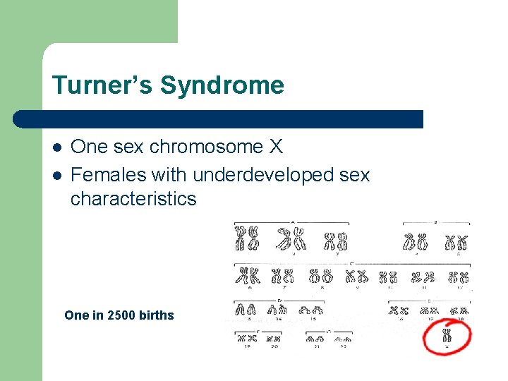 Turner’s Syndrome l l One sex chromosome X Females with underdeveloped sex characteristics One