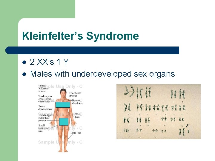 Kleinfelter’s Syndrome l l 2 XX’s 1 Y Males with underdeveloped sex organs 