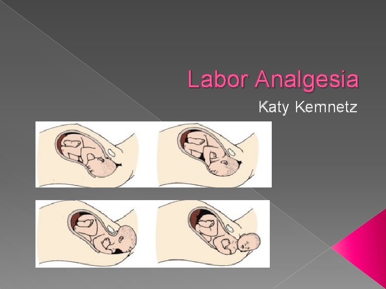 Labor Analgesia Katy Kemnetz 