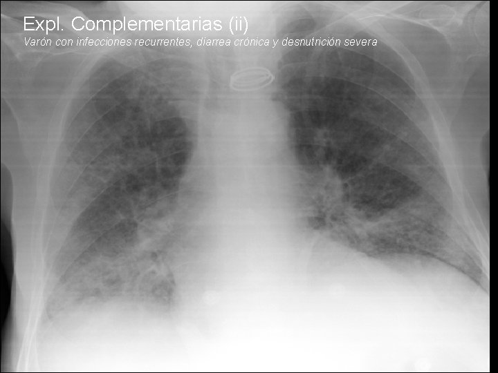 Expl. Complementarias (ii) Varón con infecciones recurrentes, diarrea crónica y desnutrición severa 