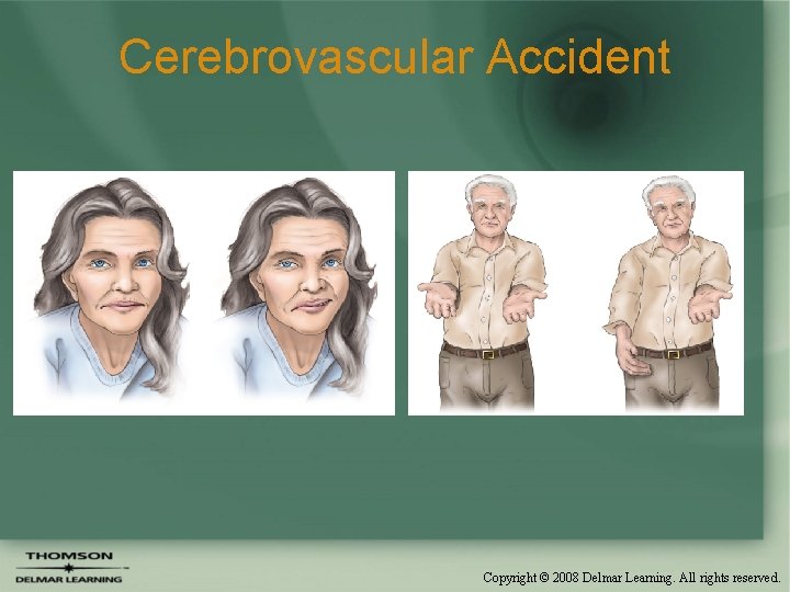 Cerebrovascular Accident Copyright © 2008 Delmar Learning. All rights reserved. 