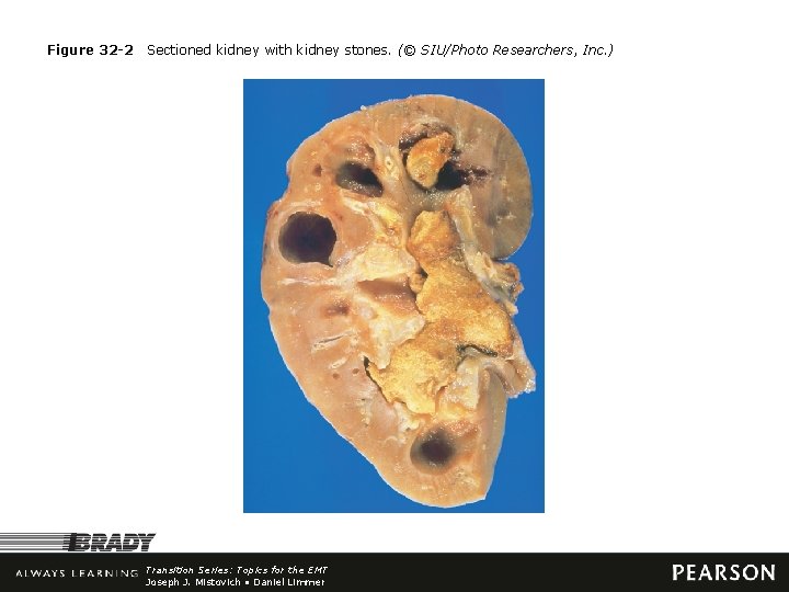 Figure 32 -2 Sectioned kidney with kidney stones. (© SIU/Photo Researchers, Inc. ) Transition